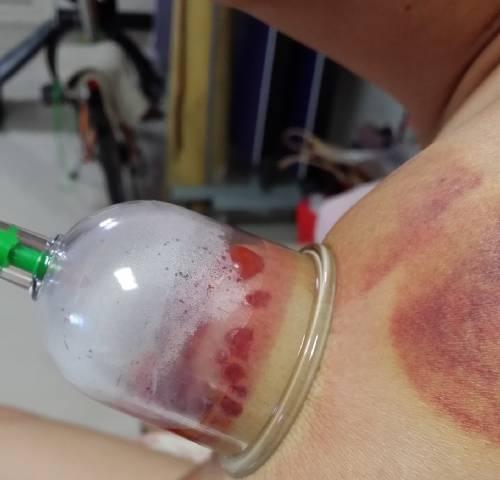 拔罐水泡的处理方法（舒缓疼痛、促进康复的有效护理方法）