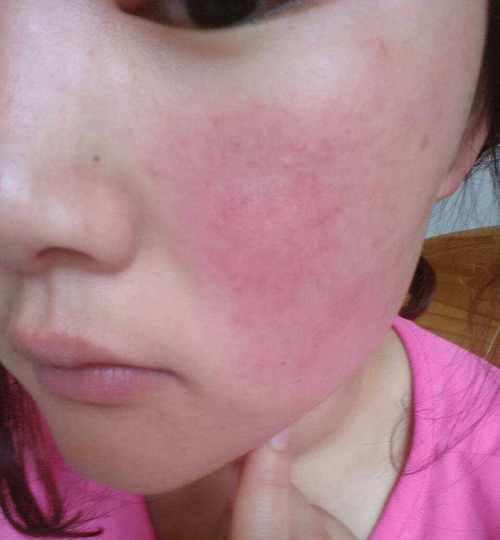 脸颊红血丝修复的方法（告别红血丝）