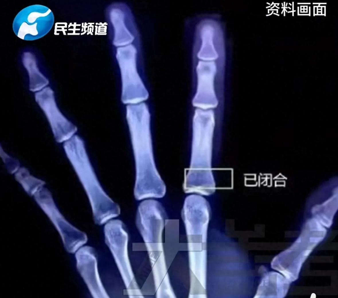 13岁男孩过度进补，一天吃四顿身高定格170